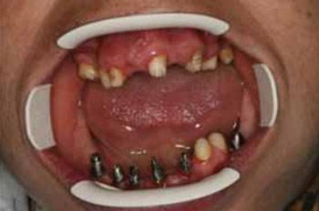 Implant Supported Prosthesıs in a Patıent wıth Progerıa: Case Report
