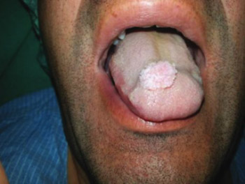 Warts on your tongue - Agenți cauzali ai verucilor genitale