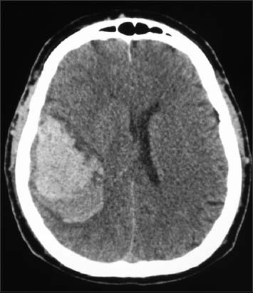 Non-endoscopic minimally invasive evacuation of intracerebral hematoma  (ICH): A case report | Biomolecules and Biomedicine