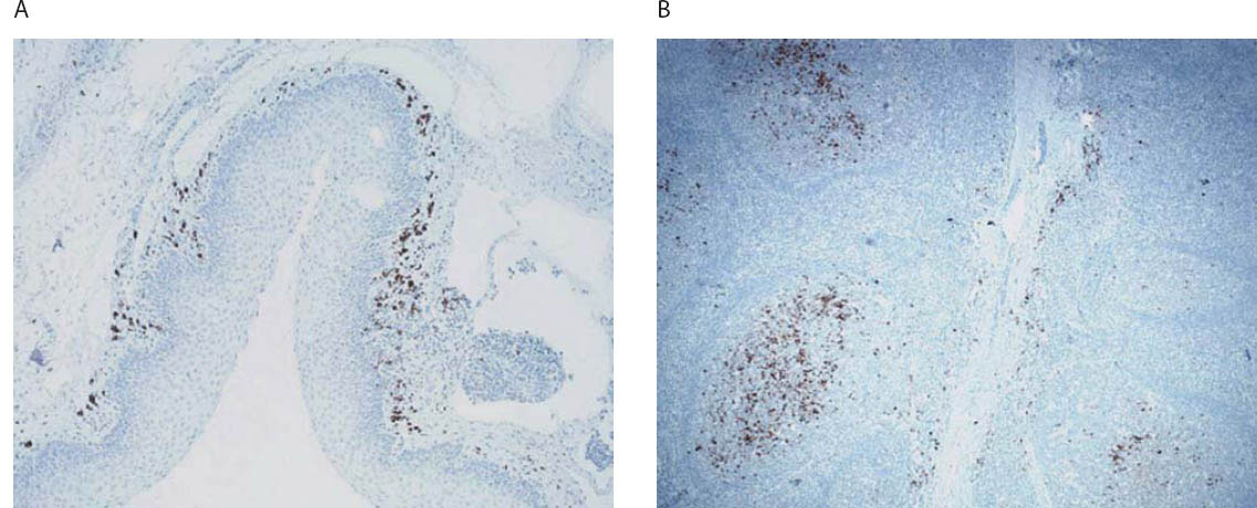 tonsillar hypertrophy score