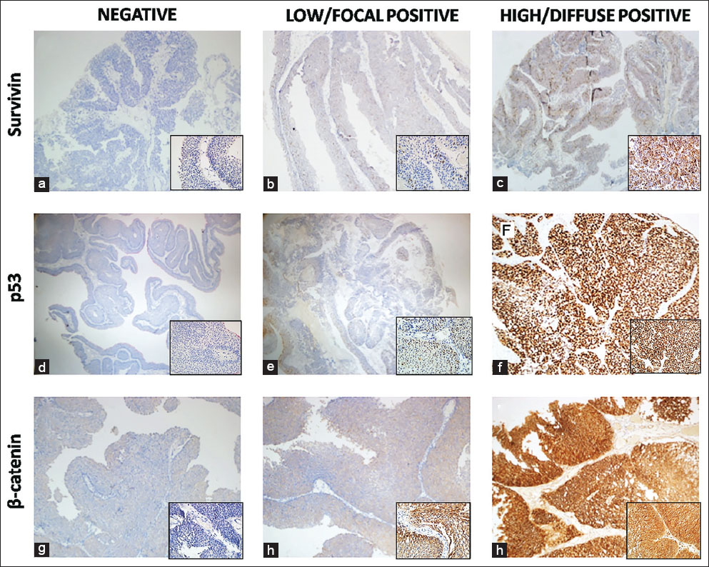 Prognostic Significance Of Survivin B Catenin And P53 Expression In Urothelial Carcinoma Bosnian Journal Of Basic Medical Sciences