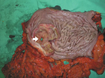 Perforation of gastric cancer - What should the surgeon do?