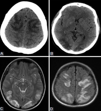 Atypical presentation of posterior reversible encephalopathy syndrome: Clinical and radiological characteristics in eclamptic patients