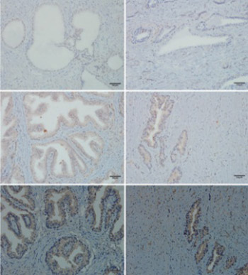 Differential expression of androgen, estrogen, and progesterone receptors in benign prostatic hyperplasia