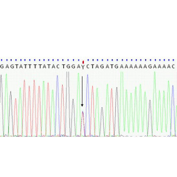 Missense splice variant (g.20746A>G, p.Ile183Val) of interferon gamma receptor 1 (IFNGR1) coincidental with mycobacterial osteomyelitis - a screen of osteoarticular lesions