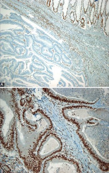 Microsatellite instability and B-type Raf proto-oncogene mutation in colorectal cancer: Clinicopathological characteristics and effects on survival