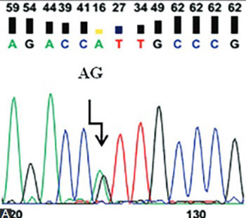 Combination effect of cytochrome P450 1A1 gene polymorphisms on uterine leiomyoma: A case-control study