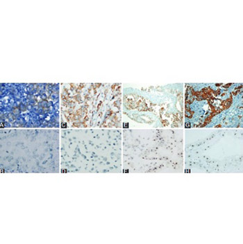 Human epidermal growth factor receptor 2 (HER-2) status evaluation in advanced gastric cancer using immunohistochemistry versus silver in situ hybridization