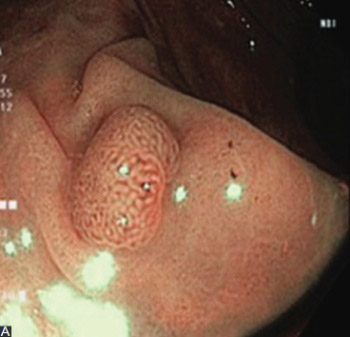 The role of narrow band imaging in colorectal polyp detection