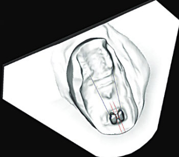 Dose- and time-dependent effects of clodronate on orthodontic tooth movement