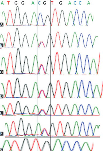 A silent mutation in human alpha-A crystallin gene in patients with age-related nuclear or cortical cataract