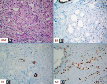 Apocrine carcinoma of the breast: A brief update on the molecular features and targetable biomarkers