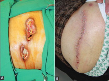 Nicolau Syndrome after Intramuscular Injection of Non-Steroidal Anti-Inflammatory Drugs (NSAID)