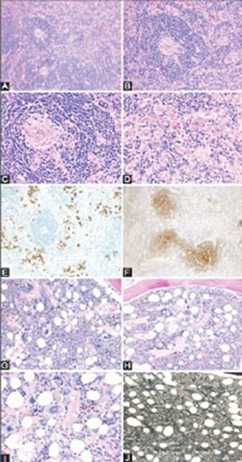 TAFRO syndrome: New subtype of idiopathic multicentric Castleman disease