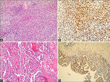 Enhancer of zeste homologue 2 (EZH2) expression in synovial sarcomas as a promising indicator of prognosis