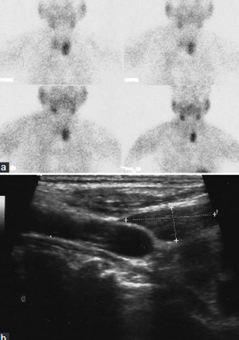 Evaluation of Conventional Imaging Techniques on Preoperative Localization in Primary Hyperparathyroidism