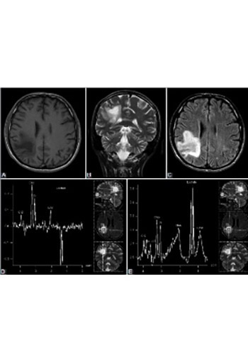A prominent lactate peak as a potential key magnetic resonance spectroscopy (MRS) feature of progressive multifocal leukoencephalopathy (PML): Spectrum pattern observed in three patients