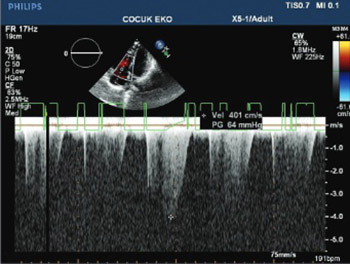 Evaluation of pulmonary artery pressure in patients with juvenile systemic lupus erythematosus (jSLE)