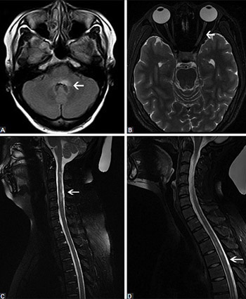 Comprehensive analysis of patients with neuromyelitis optica spectrum disorder (NMOSD) combined with chronic hepatitis B (CHB) infection and seropositive for anti-aquaporin-4 antibody