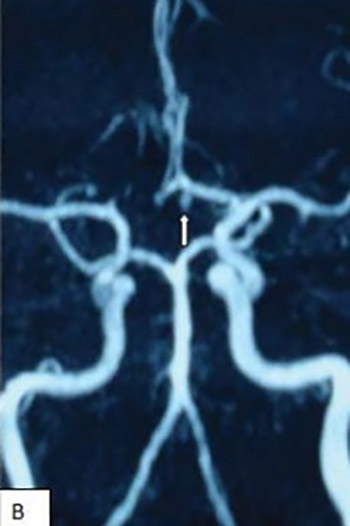 Treatment of aneurysms arising from the proximal (A1) segment of the anterior cerebral artery