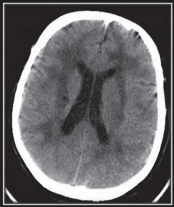 De novo mutation in the NOTCH3 gene causing CADASIL