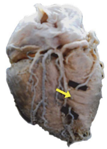 Morphological aspects of myocardial bridges