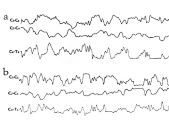 Electrophysiological Effects of Bosentan in Rats with Induced Cerebral Ischemia-Reperfusion