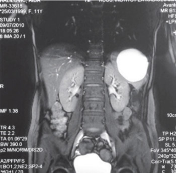 Spleen-Preserving Surgery in Treatment of Large Mesothelial Splenic Cyst in Children - A Case Report and Review of the Literature