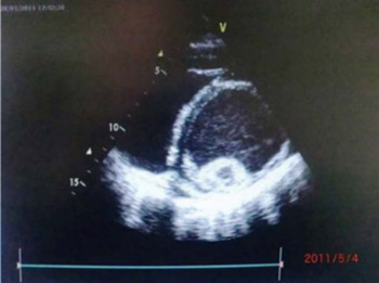 Anaesthesia in Naxos disease: First case report