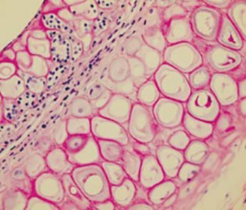 The effect of subcutaneous Insulin-like Growth Factor-1 (IGF-1) injection on rabbit auricular cartilage autograft viability