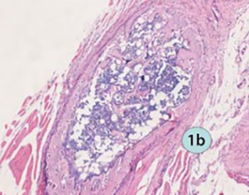 Injectable calcium phosphate cement and fibrin sealant recombined human bone morphogenetic protein-2 composite in vertebroplasty: an animal study