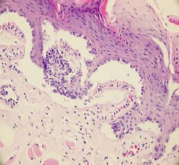 The comparison of thermal tissue injuries caused by ultrasonic scalpel and electrocautery use in rabbit tongue tissue