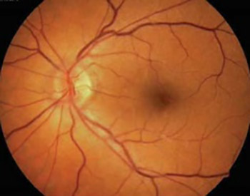 Persistent submacular fluid diagnosed with Optical Coherence Tomography after successful scleral buckle surgery for macula-off retinal detachment