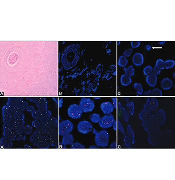 Standardization and optimization of fluorescence in situ hybridization (FISH) for HER-2 assessment in breast cancer: A single center experience