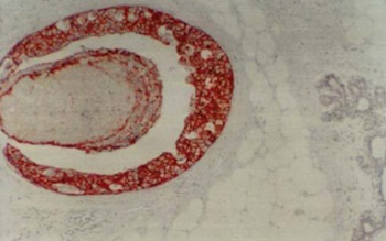 C-Erb-b2 Oncogene Expression in Intraductal Proliferative Lesions of the Breast