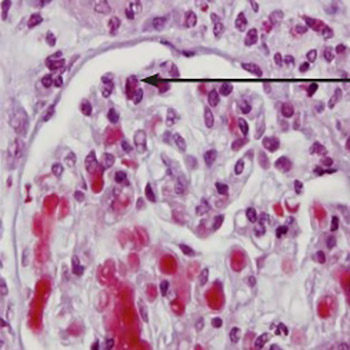 Microscopic polyangiitis presented with polyneuropathy of lower extremities and ANCA-associated glomerulonephritis: Case Report