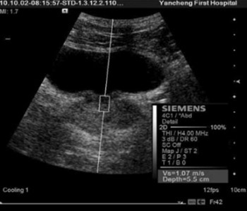 A novel and simple approach to distinguish chronic prostatitis/ chronic pelvic pain syndrome IIIb from IIIa using virtual touch tissue quantification