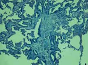 Bronchioloalveolar differentiation in lung adenocarcinomas