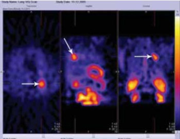 Lung 99mTc-MIBI scintigraphy: impact on diagnosis of solitary pulmonary nodule