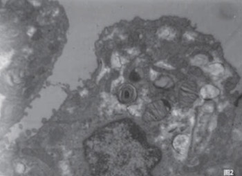 Intra-amniotic administration of exogenous pulmonary surfactant for improving in lung maturity of fetal rabbits with intrauterine infection caused by premature rupture of membranes