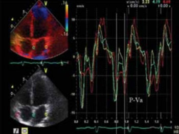 The tissue velocity imaging and strain rate imaging in the assessment of interatrial electromechanical conduction in patients with sick sinus syndrome before and after pacemaker implantation