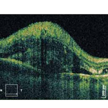 Bilateral retinal detachment in a case of preeclampsia