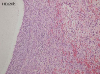 Angiosarcoma of the ovary in an 11 year old girl: Case report and review of the literature