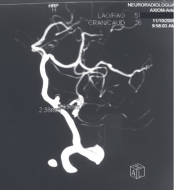 Cerebral aneurysm associated with cardiac myxoma: Case Report