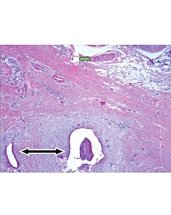 The clinical characteristics and surgical approach of scar endometriosis: A case series of 14 women