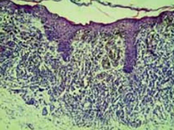 Correlation of cell cycle regulatory proteins (p53 and p16ink4a) and bcl-2 oncoprotein with mitotic index and thickness of primary cutaneous malignant melanoma