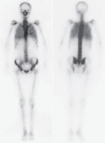 Detection of pulmonary calcification in haemodialised patients by whole-body scintigraphy and the impact of the calcification to parameters of spirometry