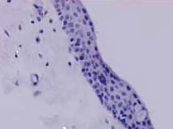 Analysis of pathohistological characteristics of pterygium