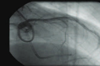 Successful Percutaneous Septal Alcohol Ablation After Surgical Myectomy