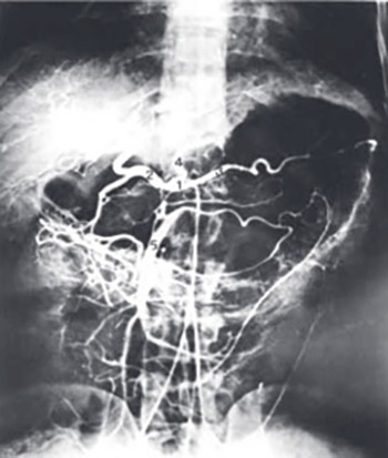 Investigation of Vascularization of Human Pancreas Using Method of Selective Arteriography with Insight Into Significance to a Surgical Approach for this Organ